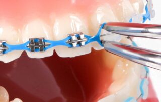 Orthodontic Braces Rubber Chains Power Chains Dental Rubber Chains for Braces Rubber Block Chain