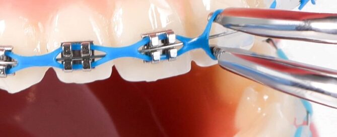 Orthodontic Braces Rubber Chains Power Chains Dental Rubber Chains for Braces Rubber Block Chain