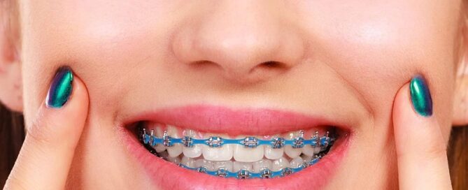 Orthodontic Braces Rubber Chains Power Chains Dental Rubber Chains for Braces Rubber Block Chain